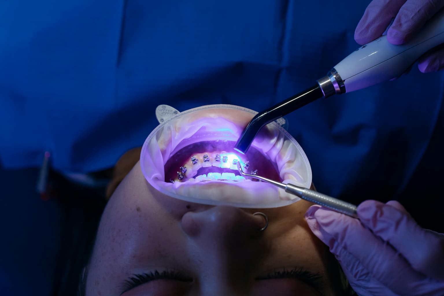 Clareamento Dental: Mitos e Verdades