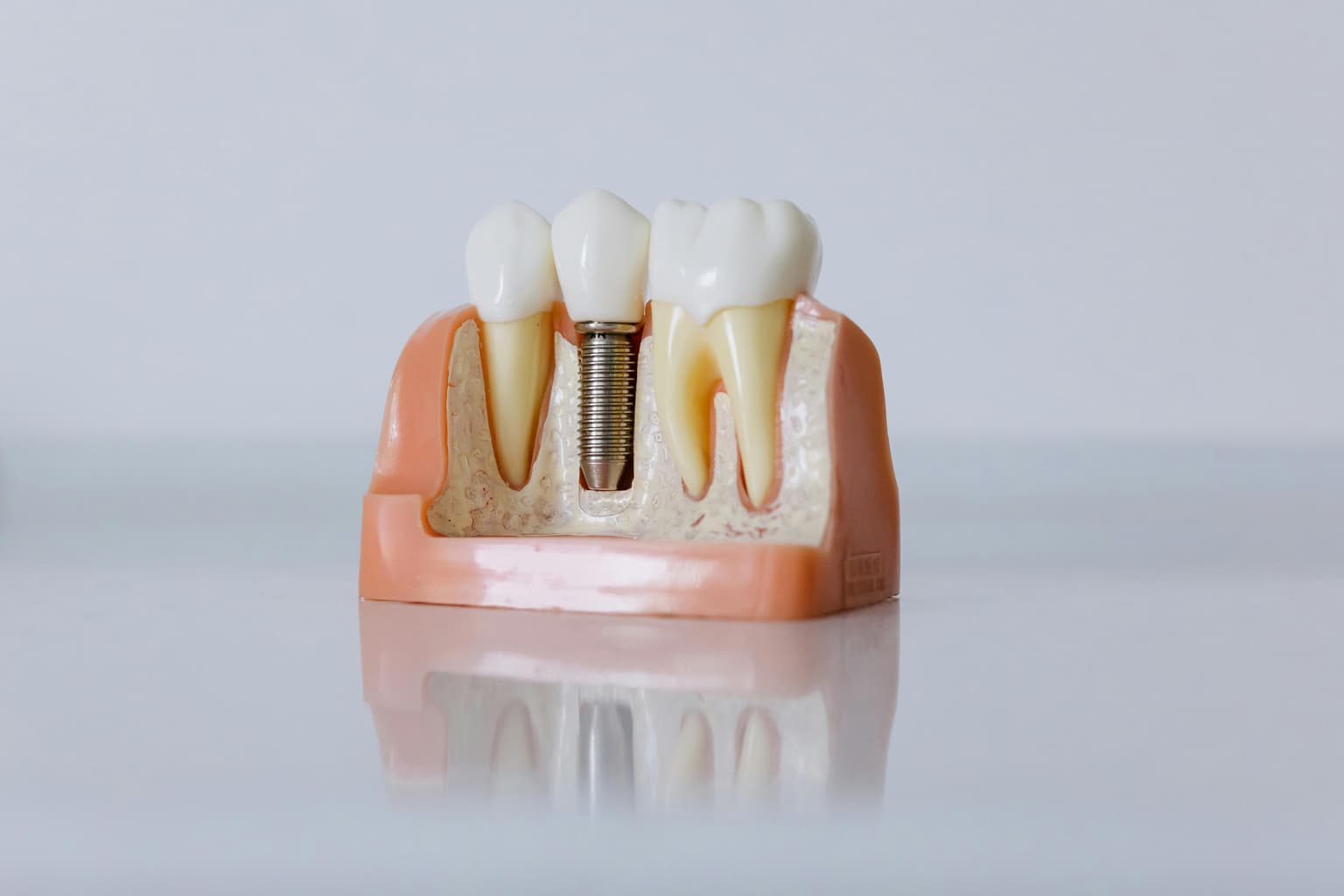 Implantes Dentários: Quando Vale a Pena?